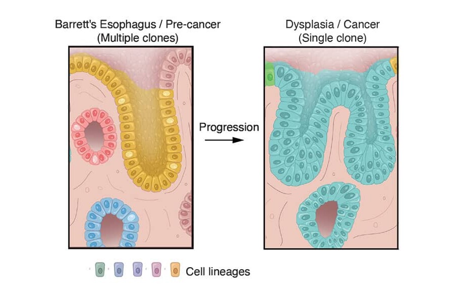 esophageal cancer at the single cell level