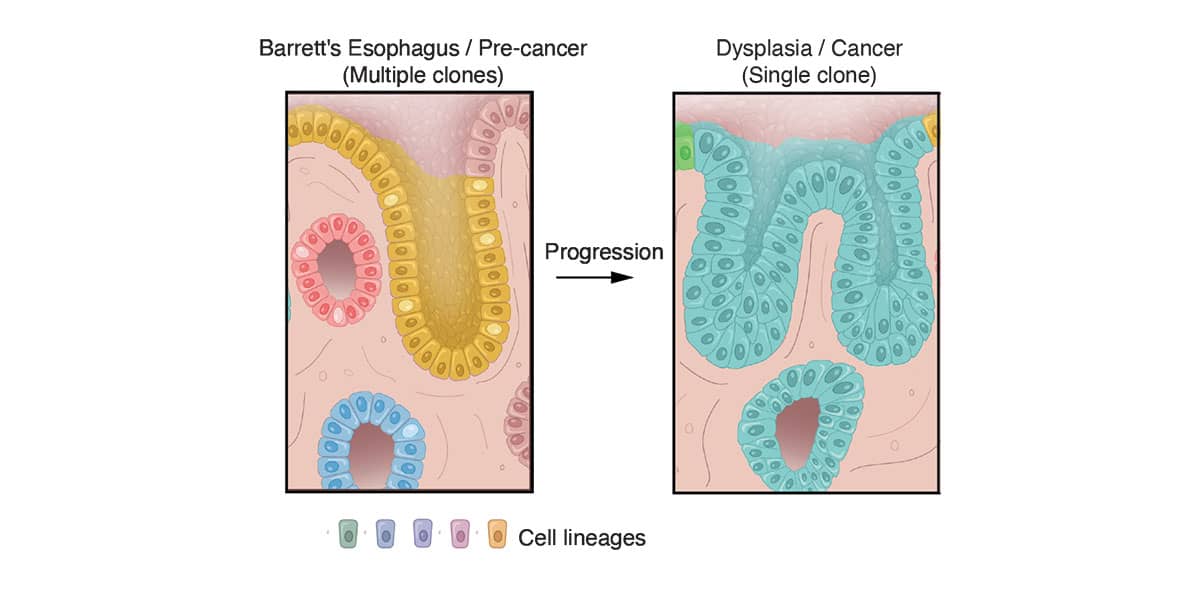 esophageal cancer at the single cell level